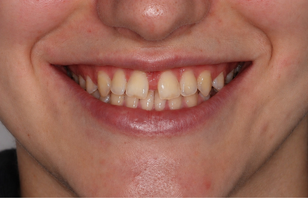 aligner-elotte-2