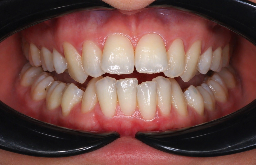 aligner-elotte-3