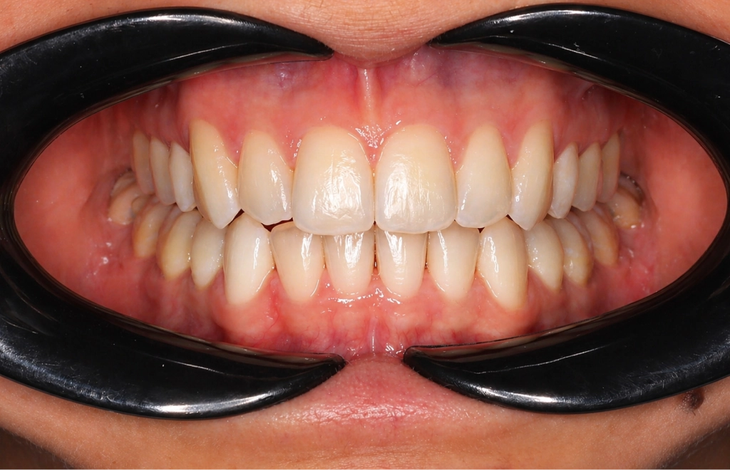 aligner-utana-3