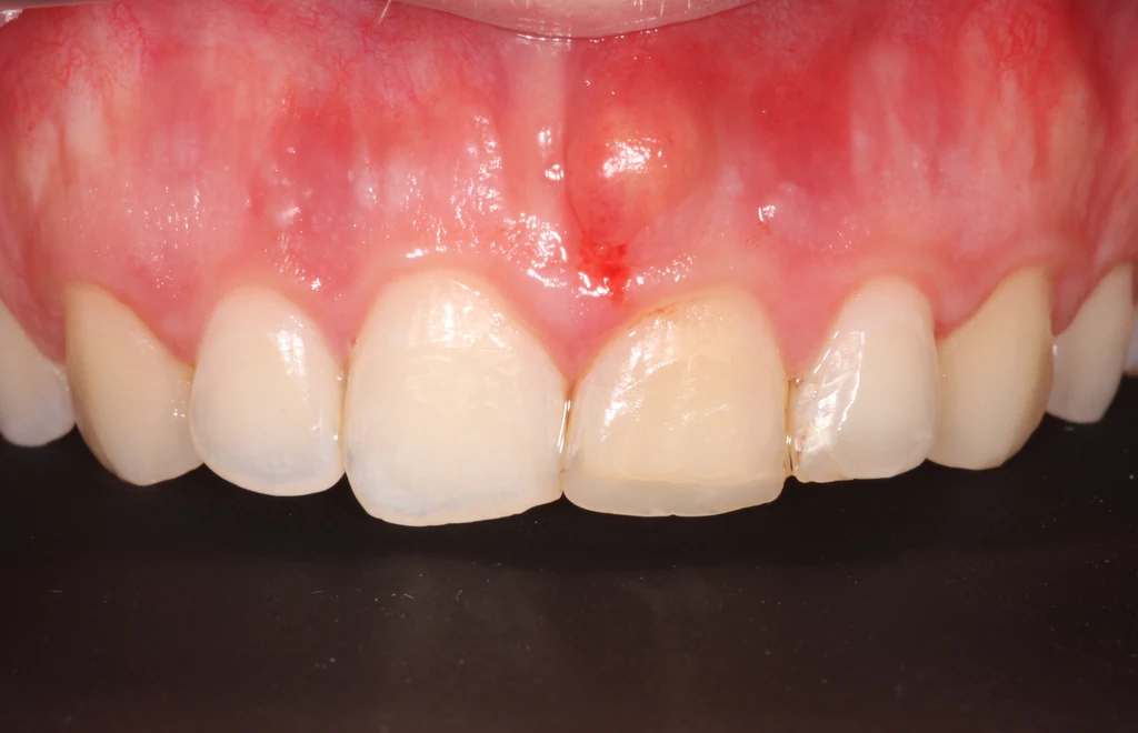 Azonnali implantáció előtti korona frontfog területen