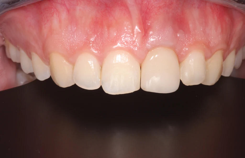 Azonnali implantáció utáni korona frontfog területen