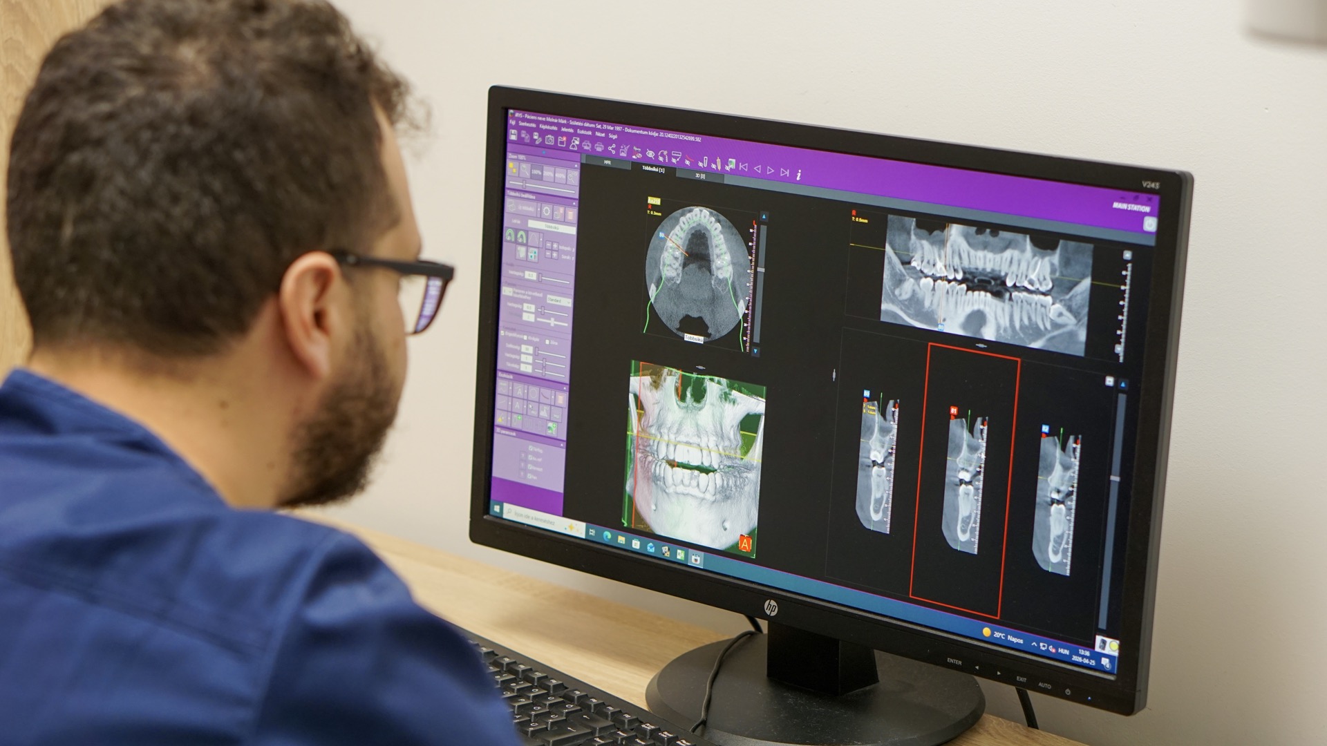 Csontpótlás menete fogimplantátum előtt CBCT tervezéssel