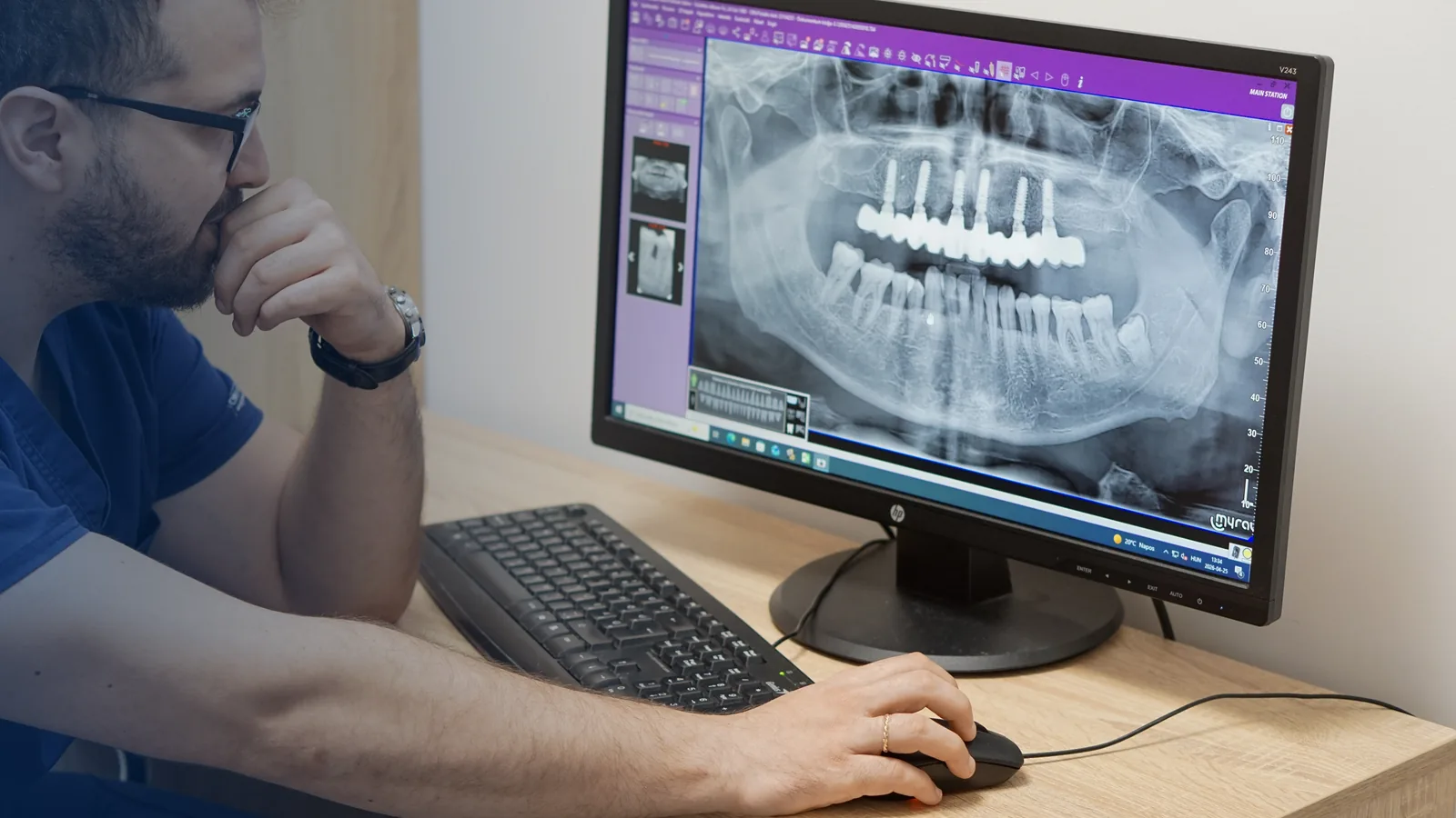 Digitális diagnosztika fogimplantátum tervezéséhez