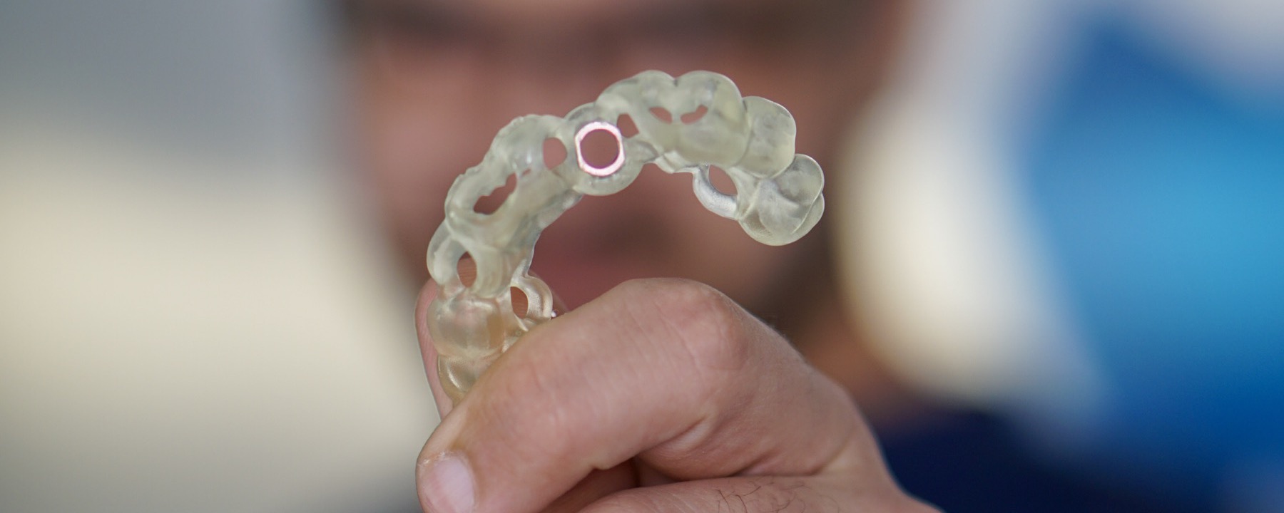 Sebészi sablon All-on-4 implantátumos fogpótlás digitális tervezéséhez